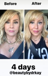 Before After Chalene Johnson