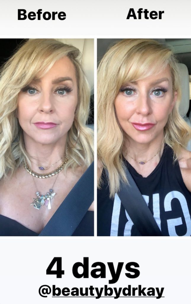 My Botox Results