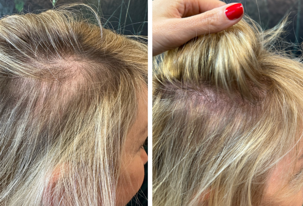 Female Hair Loss After 40