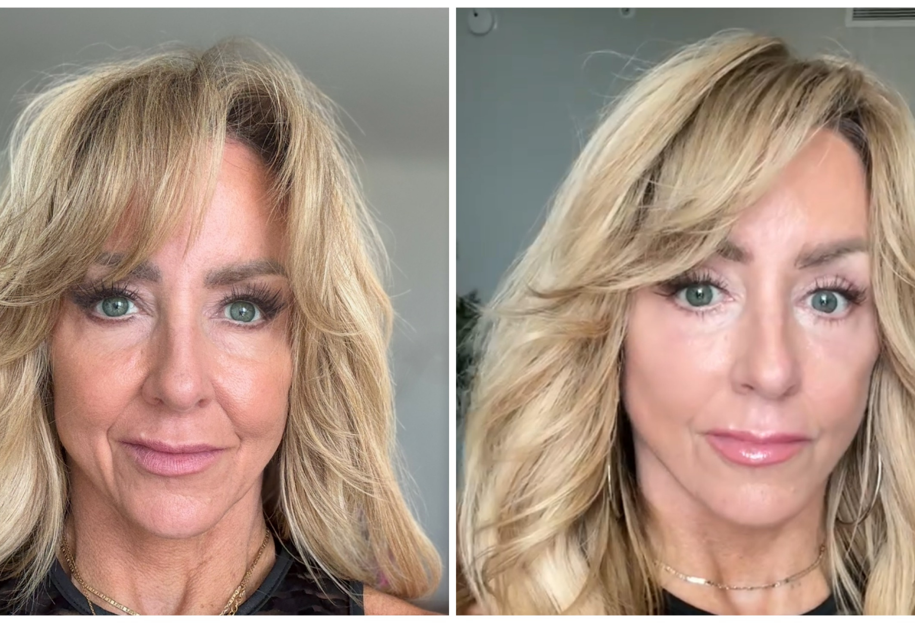 facelift regrets what to know before surgery