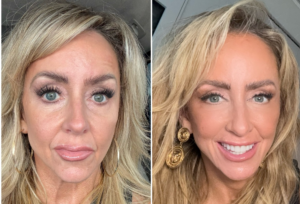 Before and after photos of Chalene Johnson showing facial symmetry improvements using Botox fillers and Sculptra cosmetic injectables